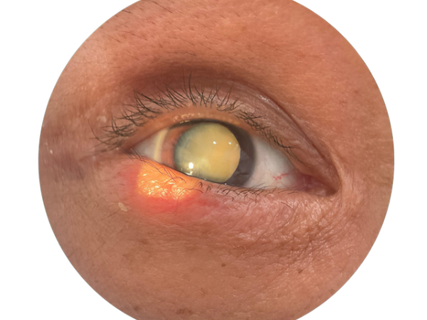 Process of Cataract Surgery Los Angeles